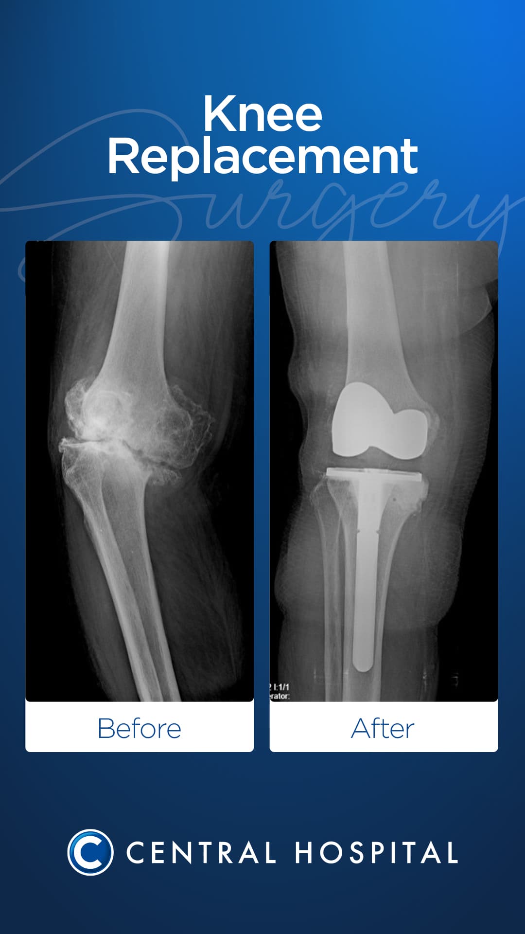 Knee Surgery — before and after — Central Hospital Istanbul