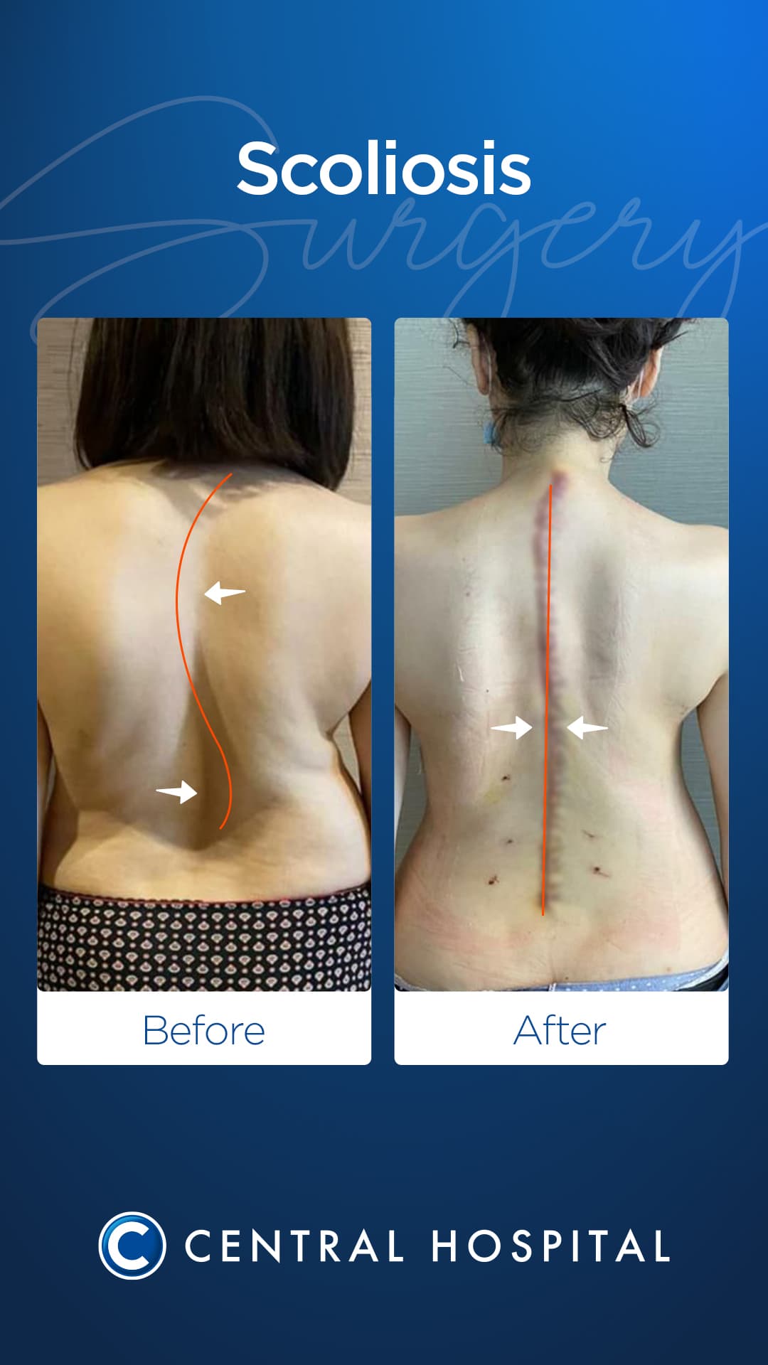 Spine Surgery — before and after — Central Hospital Istanbul