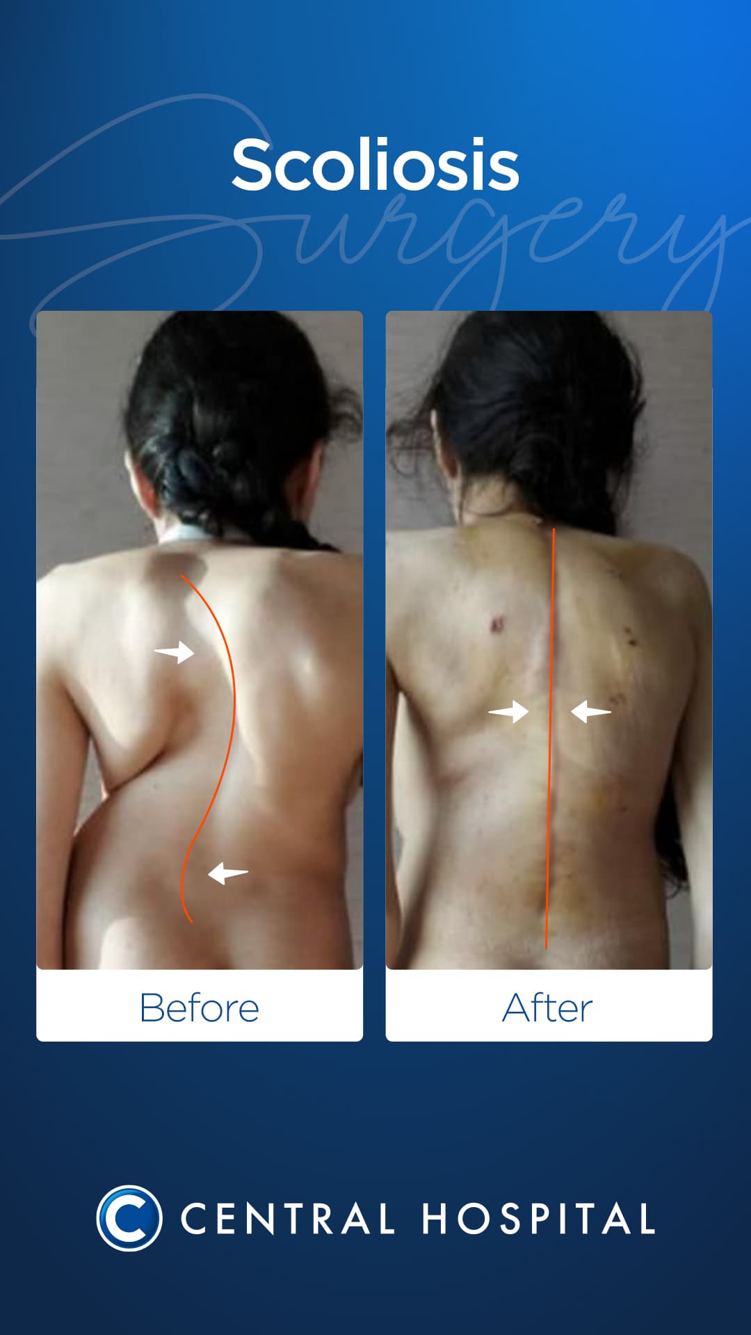 Spine Correction — before and after — Central Hospital Istanbul