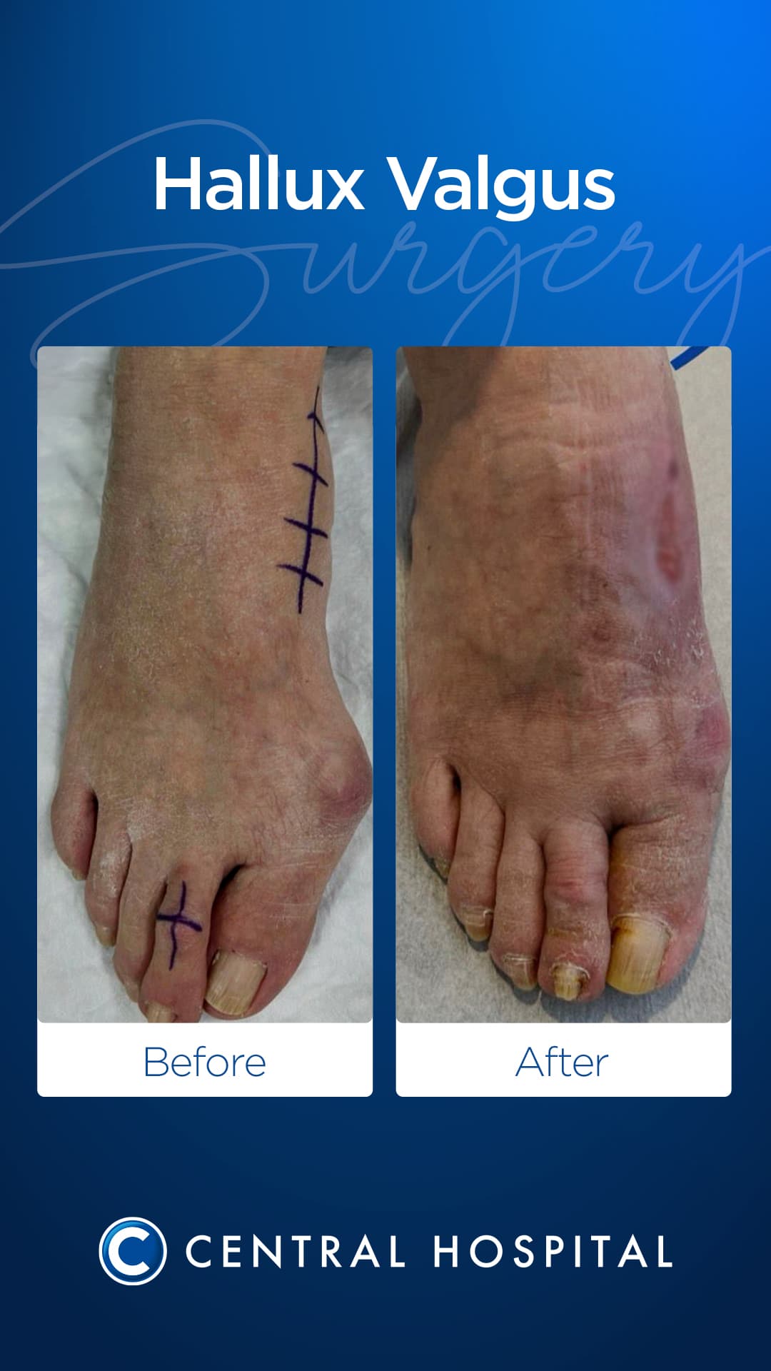 Hallux Valgus Correction — before and after — Central Hospital Istanbul