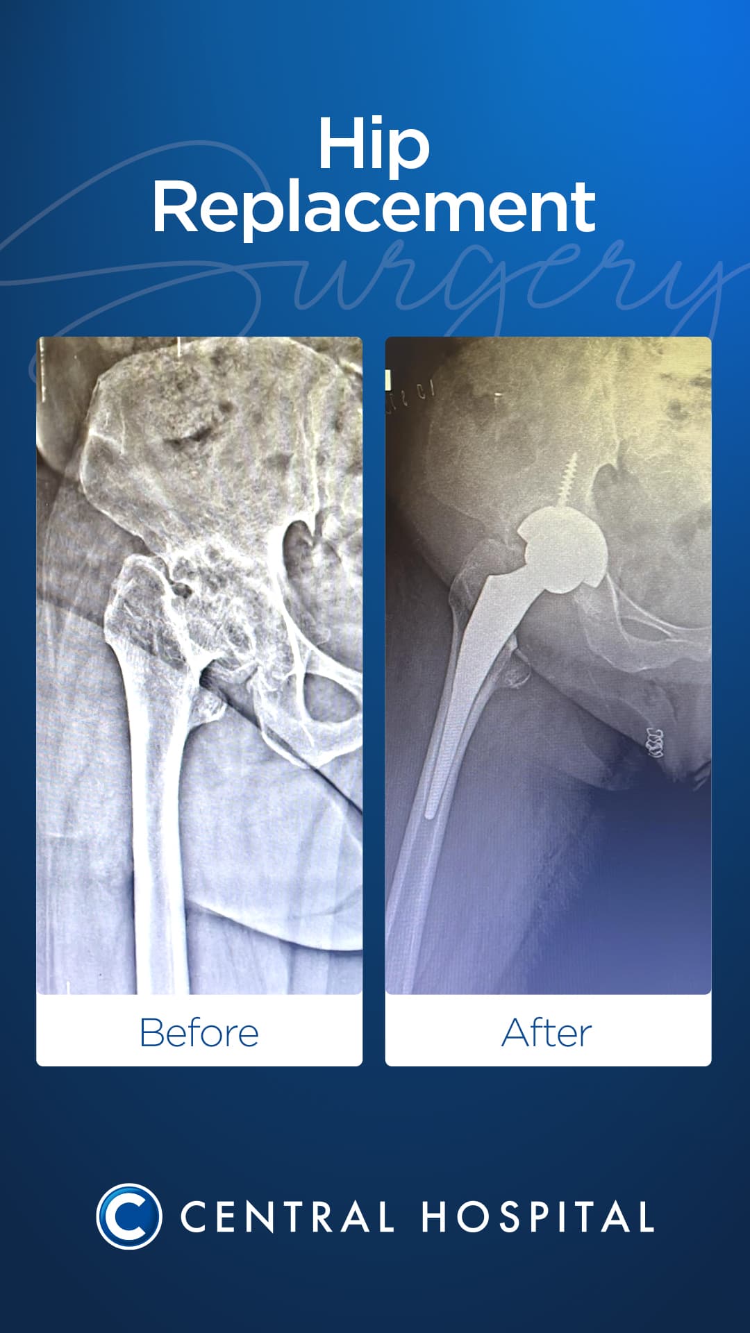 Hip Replacement — before and after — Central Hospital Istanbul