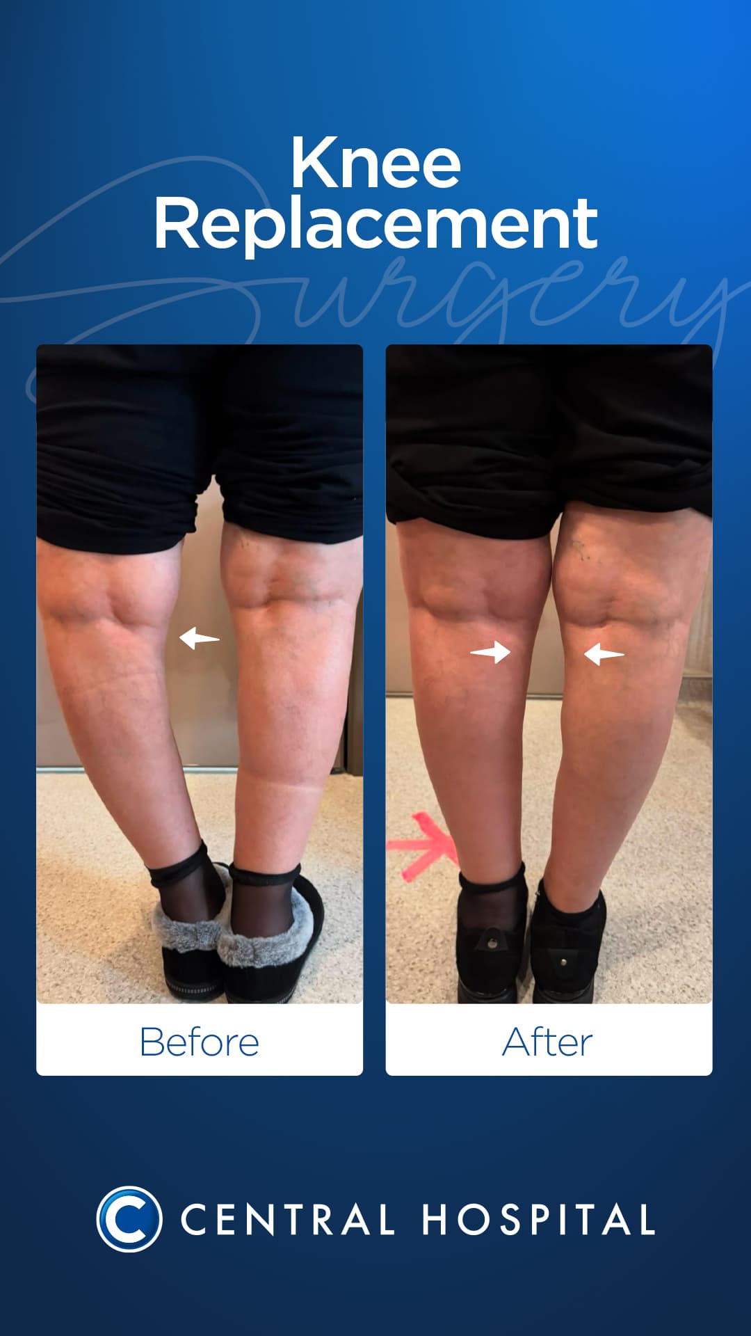Total Knee Replacement — before and after — Central Hospital Istanbul