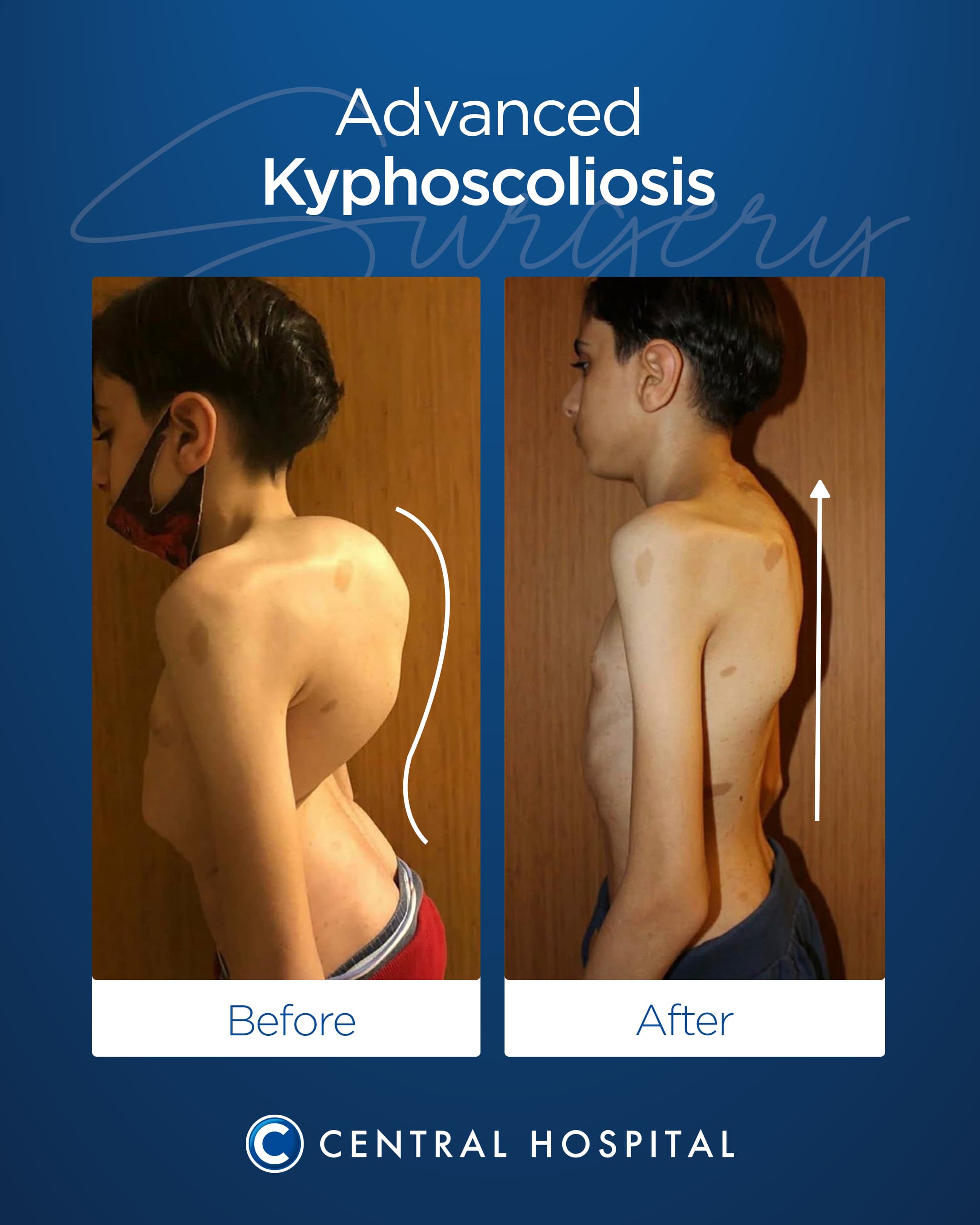 Kyphoscoliosis Surgery — before and after — Central Hospital Istanbul