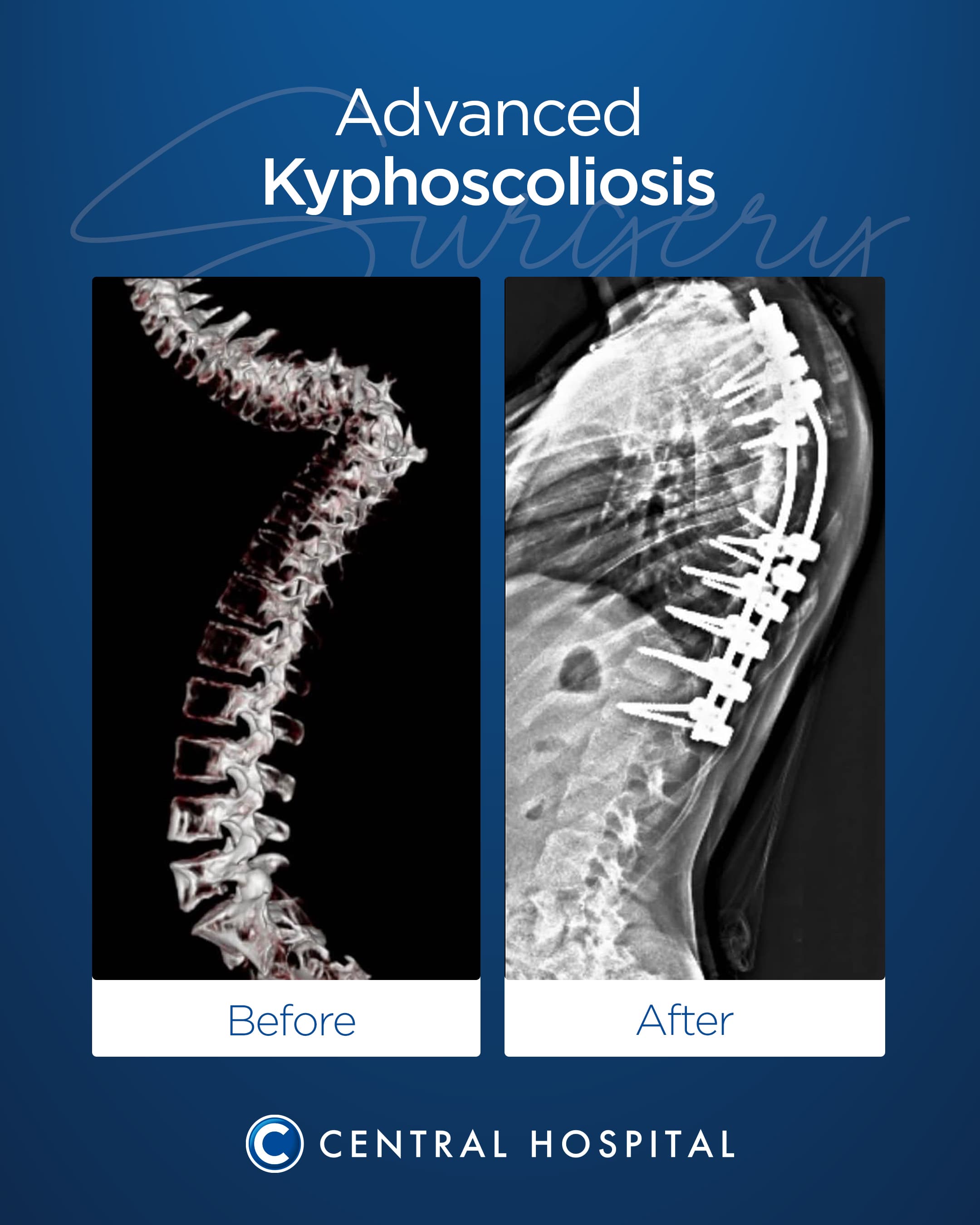 Kyphoscoliosis Surgery — before and after — Central Hospital Istanbul