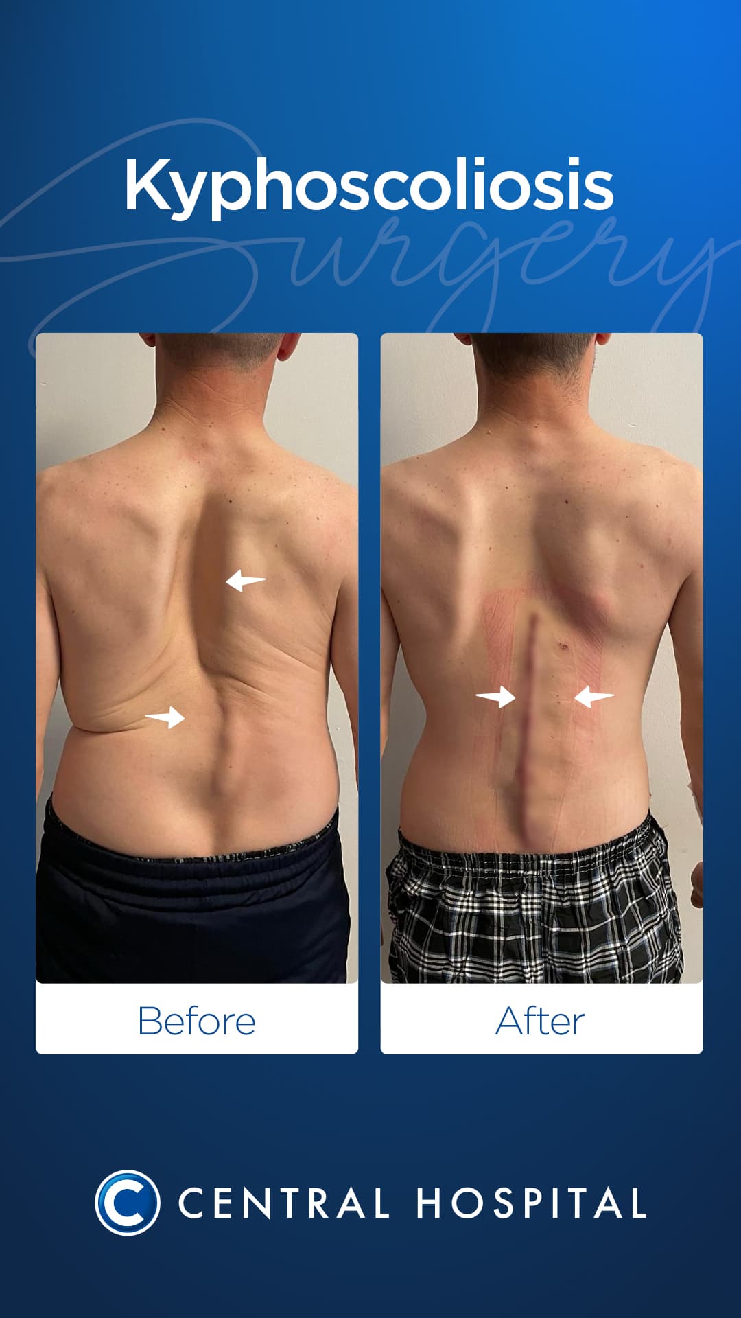 Advanced Kyphoscoliosis — before and after — Central Hospital Istanbul