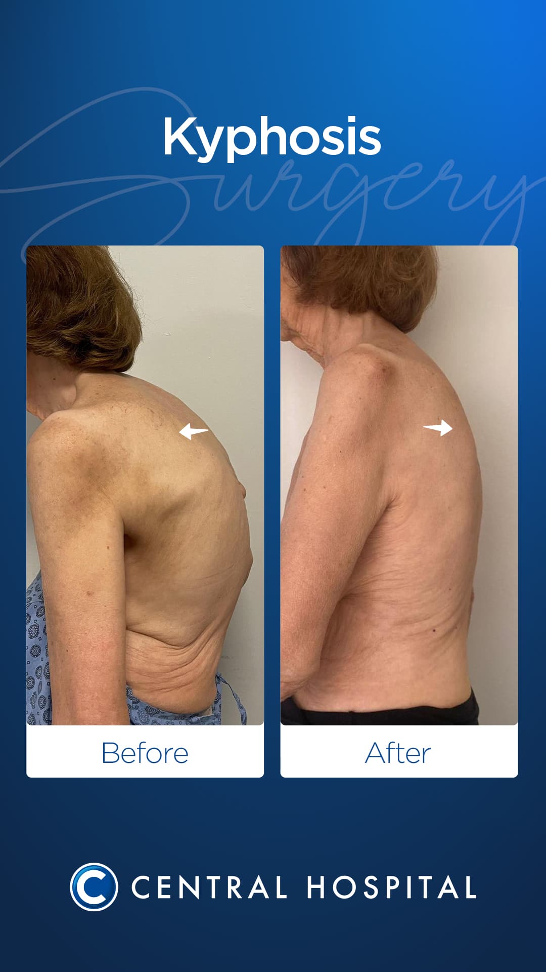 Kyphosis Surgery — before and after — Central Hospital Istanbul
