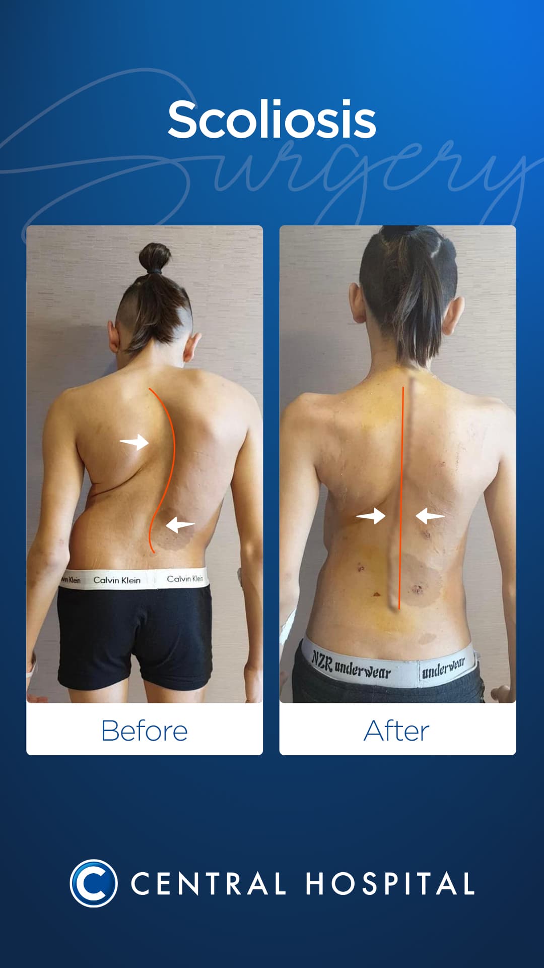 Scoliosis Surgery — before and after — Central Hospital Istanbul