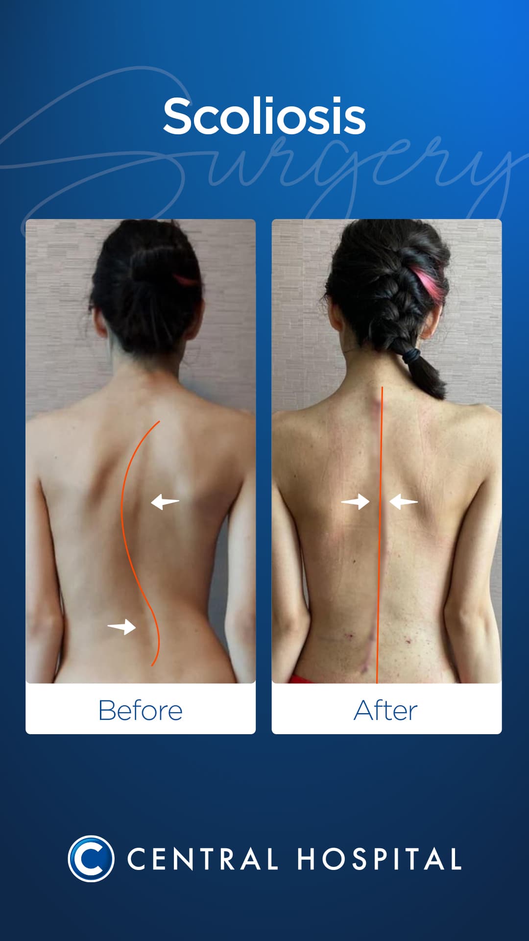 Scoliosis Surgery — before and after — Central Hospital Istanbul