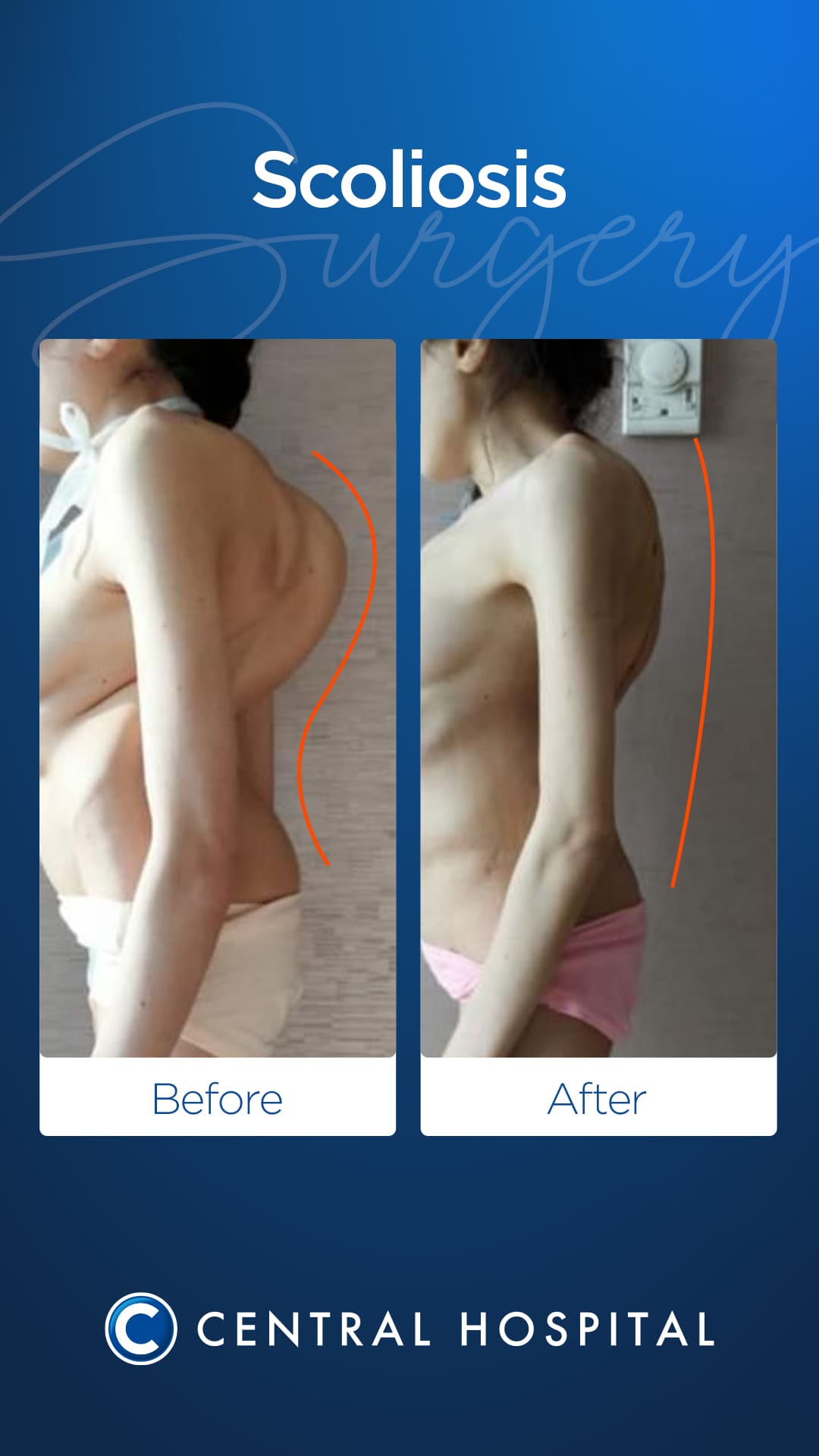 Scoliosis Surgery — before and after — Central Hospital Istanbul