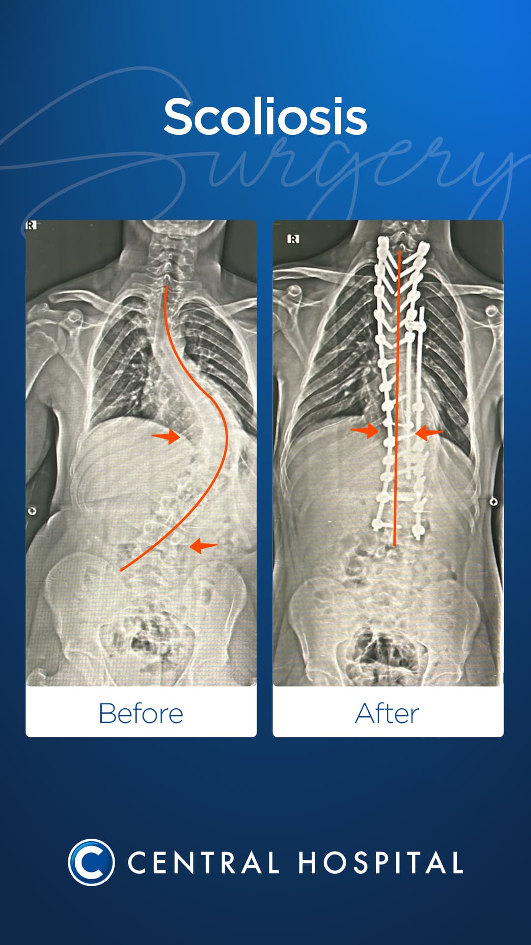 Scoliosis Surgery — before and after — Central Hospital Istanbul
