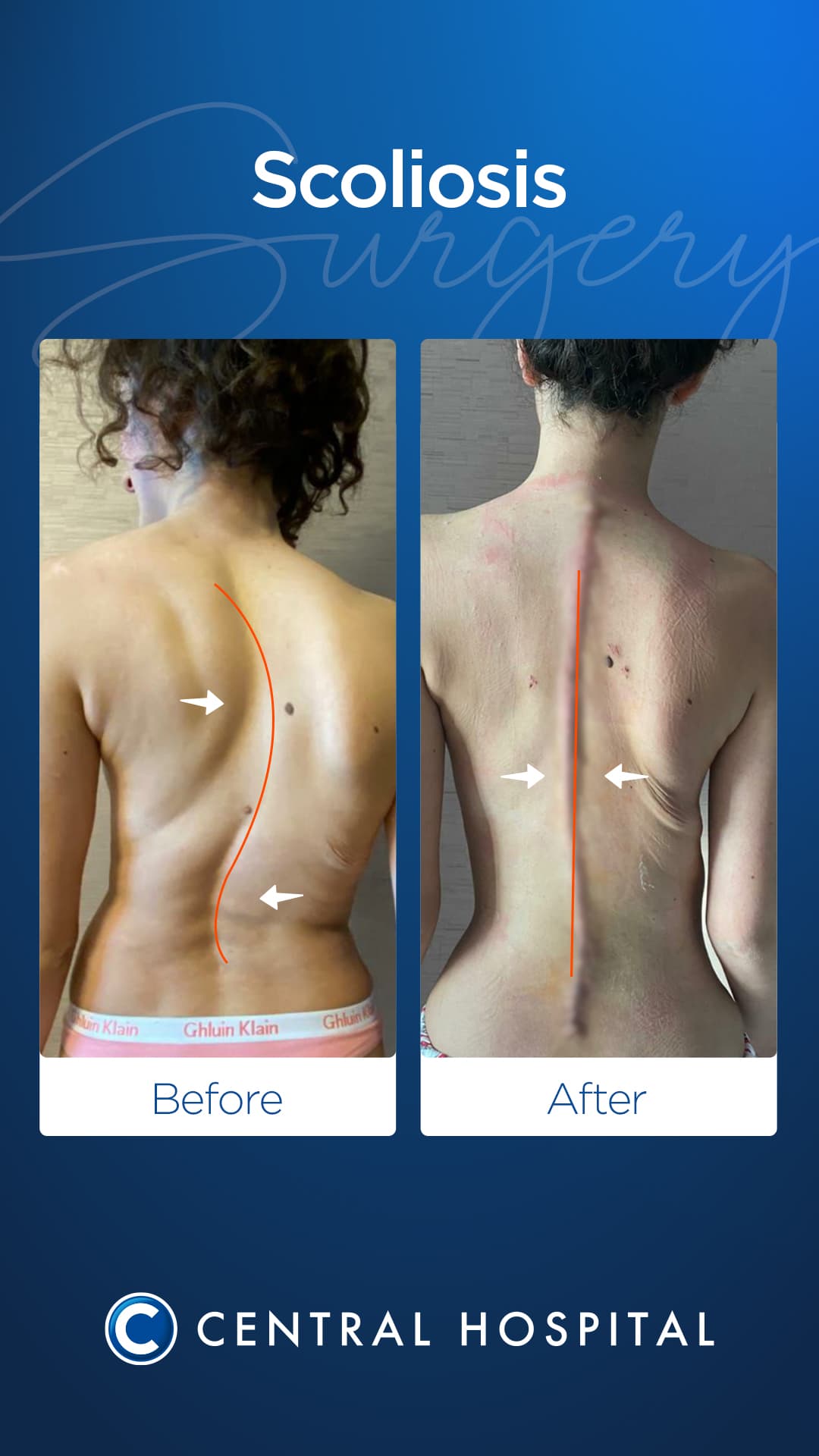 Scoliosis Surgery — before and after — Central Hospital Istanbul