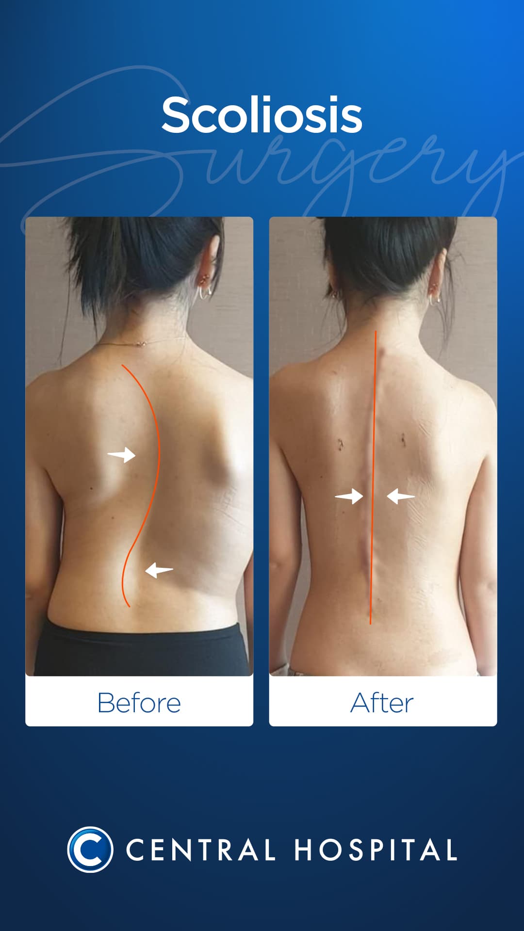 Scoliosis Surgery — before and after — Central Hospital Istanbul