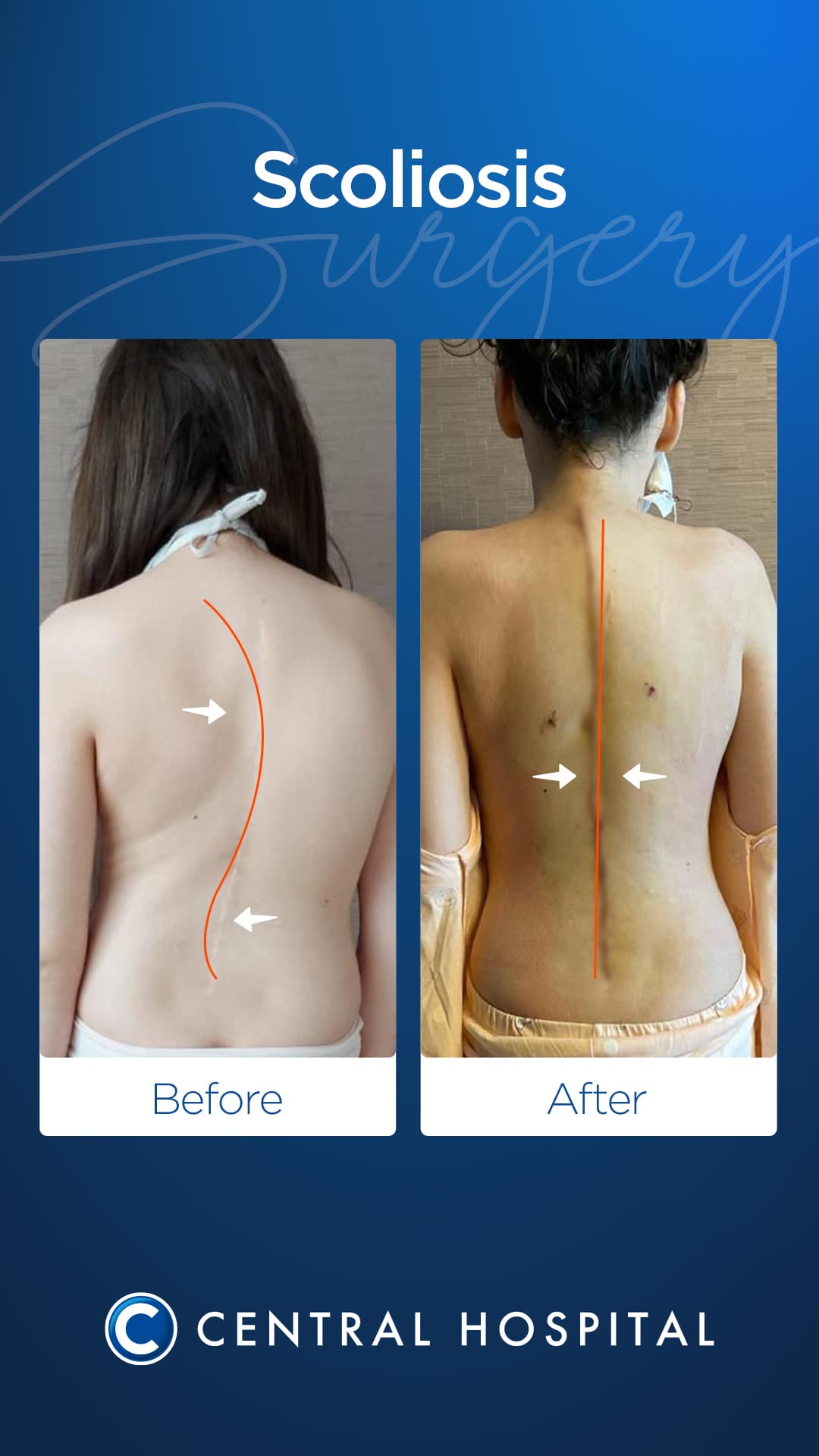 Scoliosis Surgery — before and after — Central Hospital Istanbul